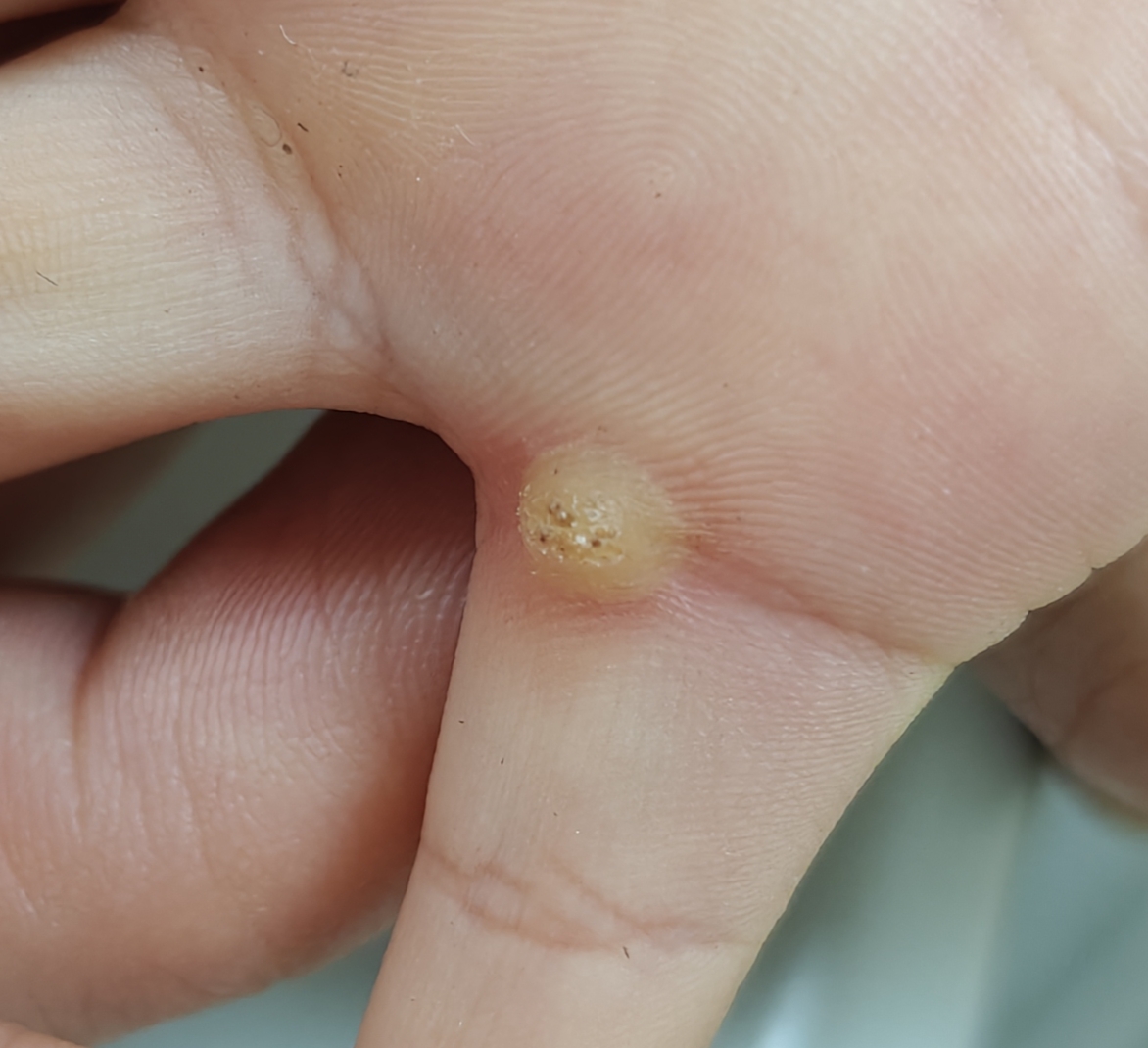 孩子手上长"猴子"了怎么办?