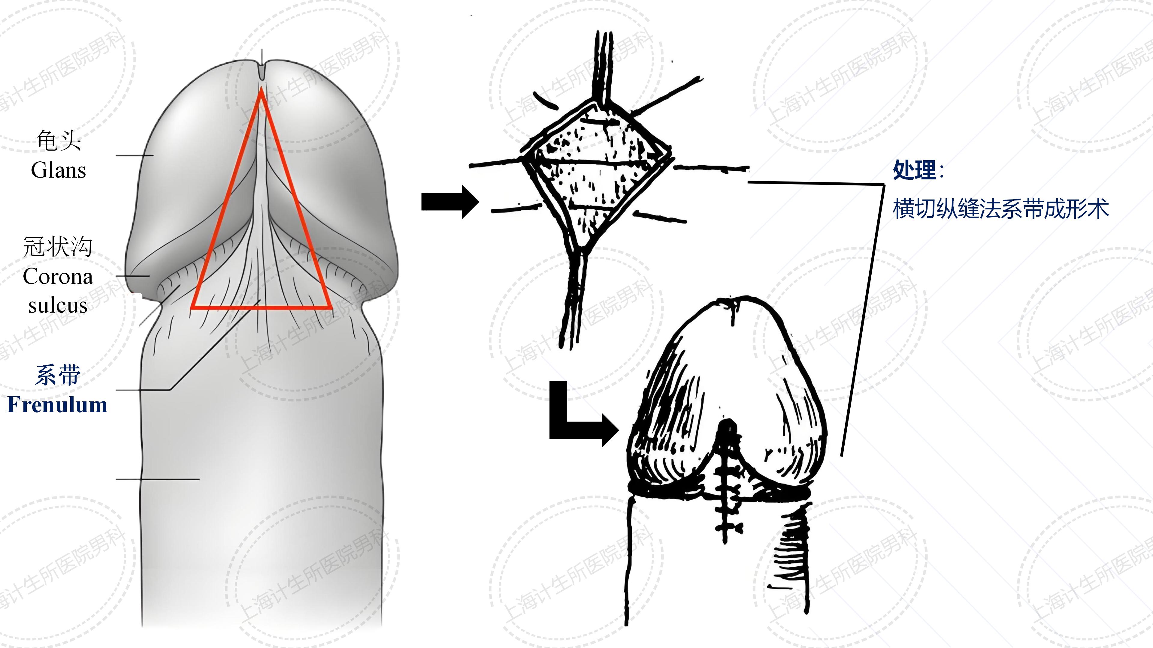 包茎——袖套式包皮环切术真实案例分享