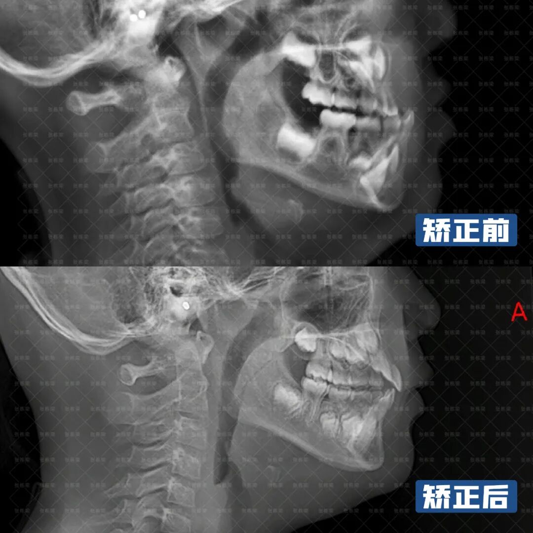 什么程度才需要正颌手术 p3BMTioNnDOjEuFJFG001779184188.png?_ms_=5584