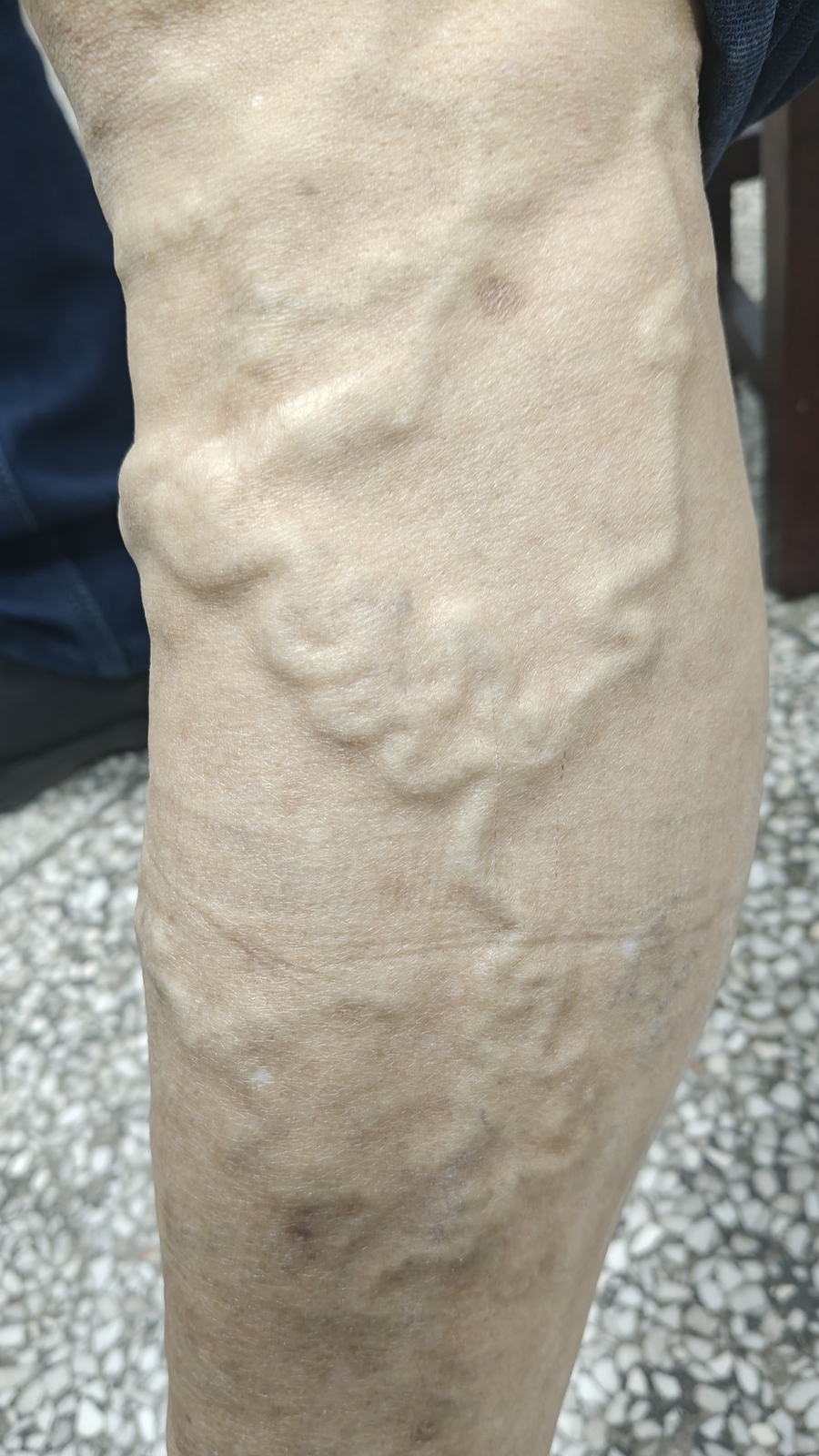 轻微静脉曲张用什么药?