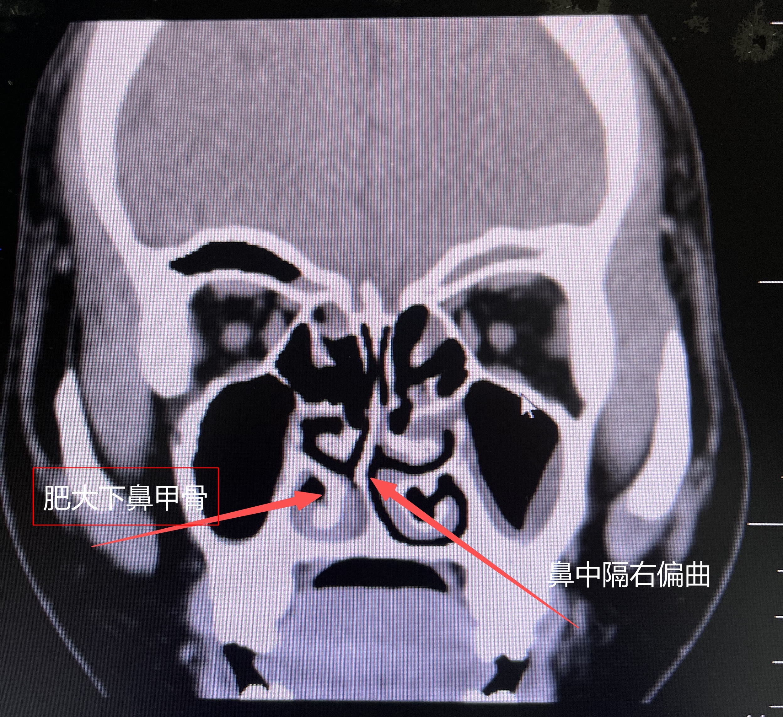 快速解决打鼾 y2lUJXGlagmdnCMeUz001770703052.png?_ms_=48ab