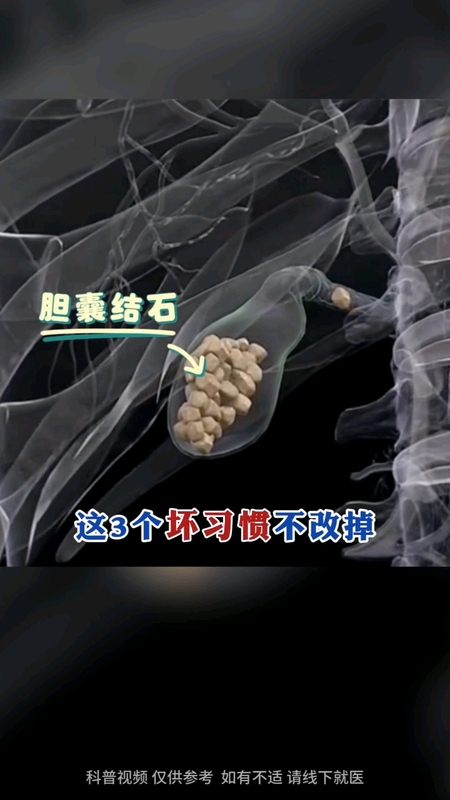 导致胆囊结石的3个坏习惯一定要改掉