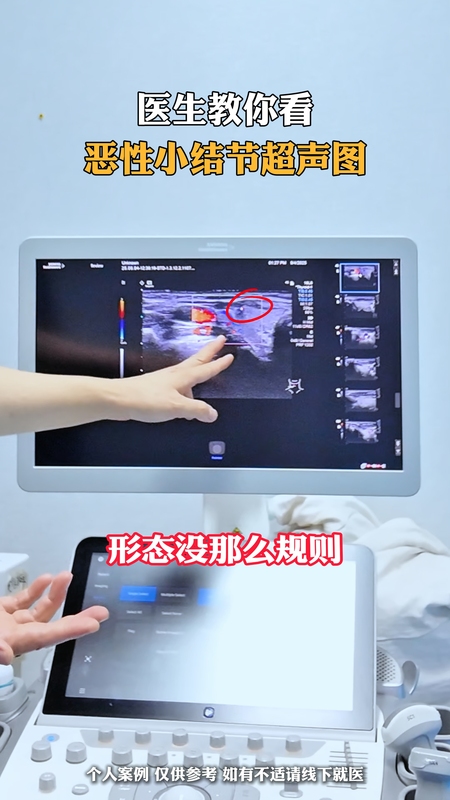 手把手，教你认识甲状腺癌的超声特征