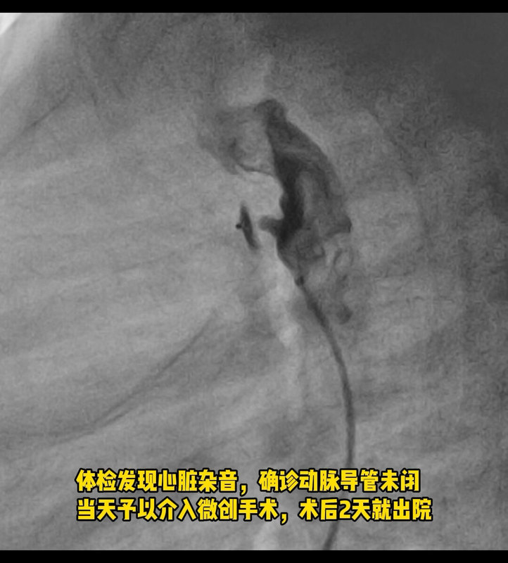 动脉导管未闭，当天手术，2天即可出现
