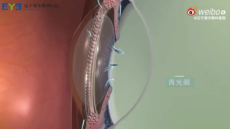 青光眼是怎么形成的？