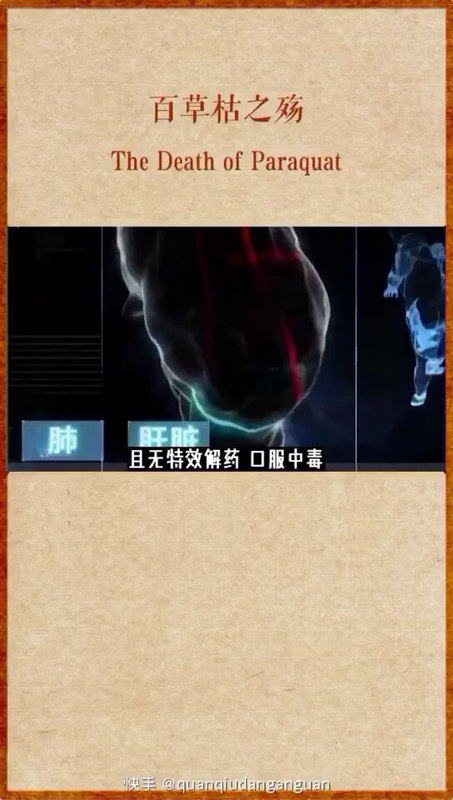 百草枯中毒（2-2）