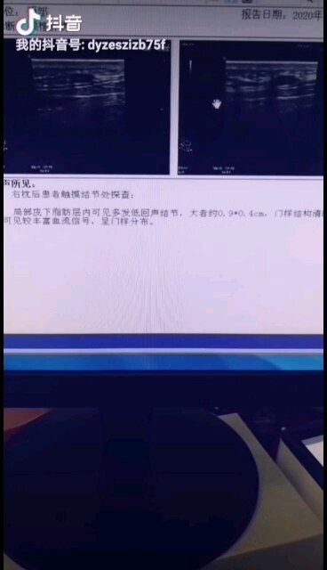 教你看懂淋巴结肿大的彩超报告