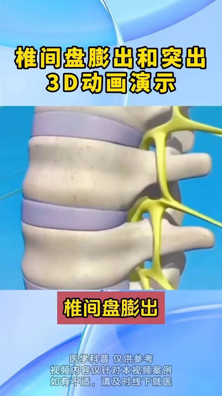 腰椎间盘突出动画演示