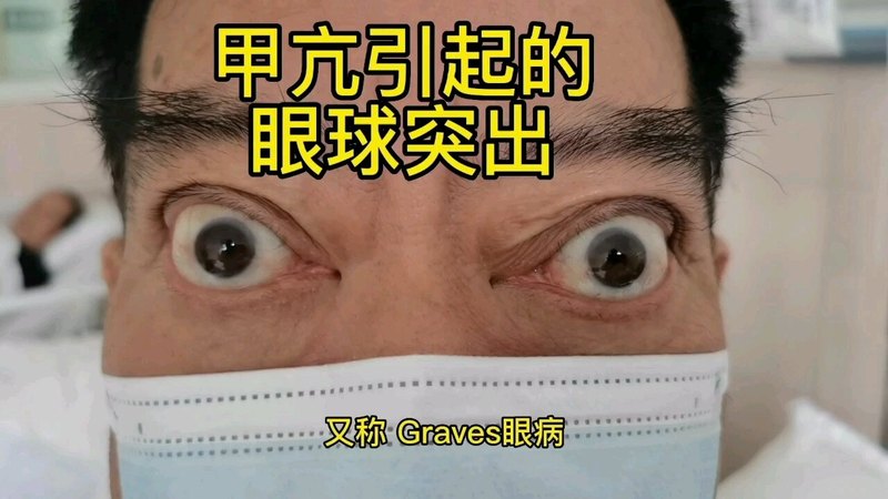 甲状腺相关性眼病