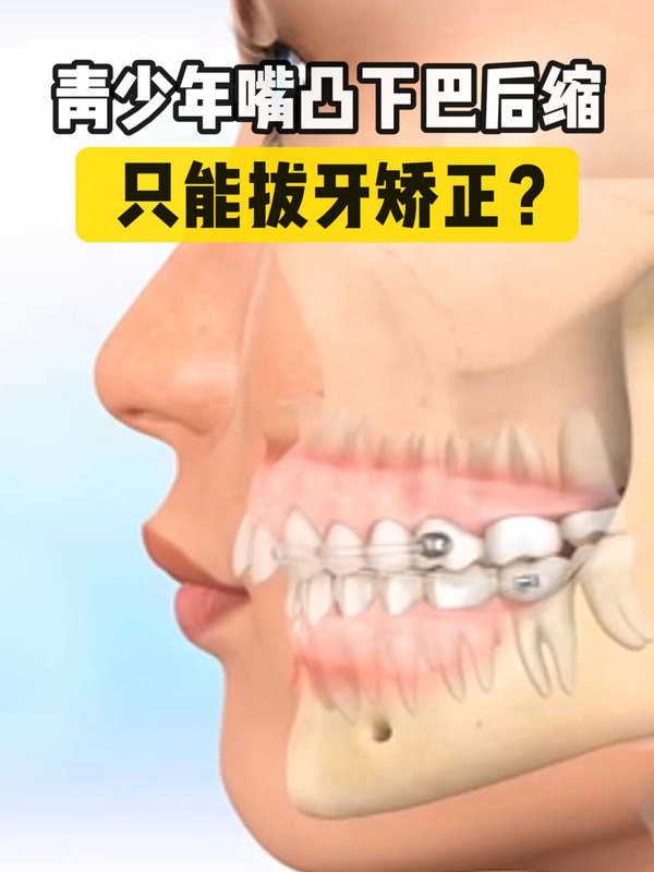 青少年嘴突下巴后缩是否只能拔牙矫正？