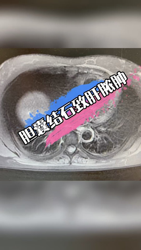 胆囊结石致肝脓肿