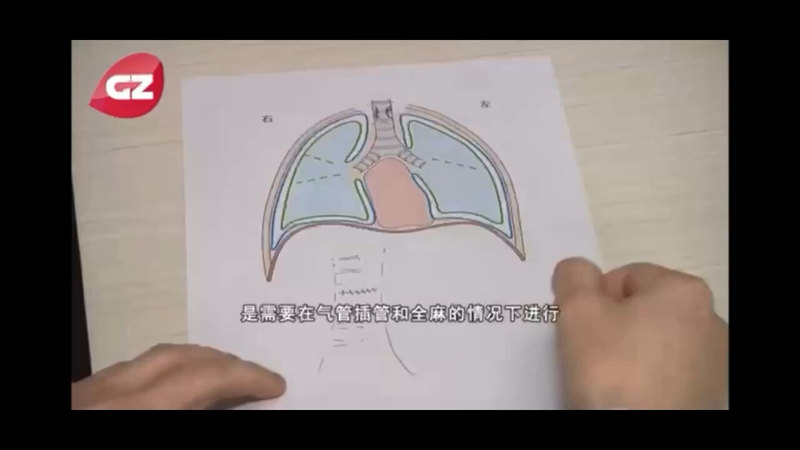 全球最小年纪的“无管化麻醉”小儿气管肿瘤切除重建术