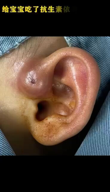 一岁宝宝耳瘘急性感染手术治疗