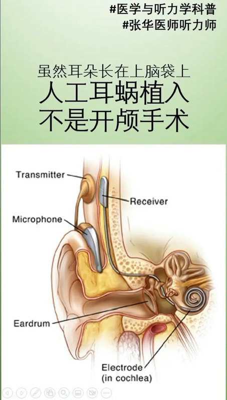人工耳蜗不是开颅手术