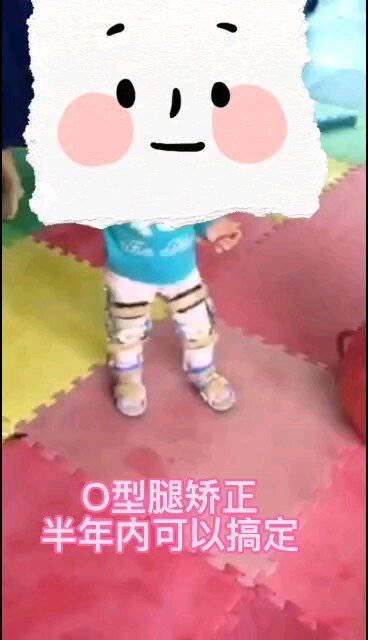 O型腿，半年内可以搞定