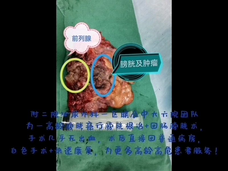 腹腔镜下膀胱癌根治术，出血极少。