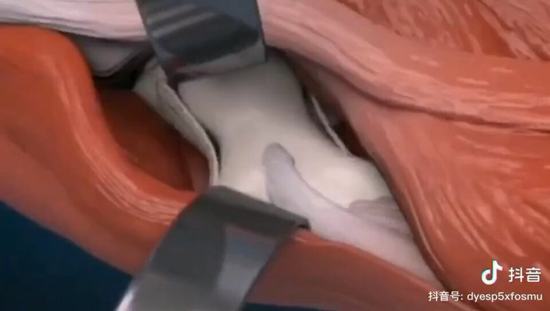全髋关节置换是治疗股骨头坏死的终级治疗方案，是目前全球骨科效价比最好的治疗，仅供参考，让大家了解一下
