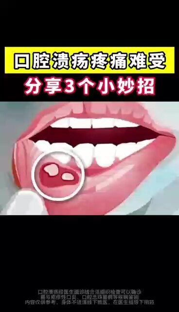 口腔溃疡疼痛难受，分享三个小妙招