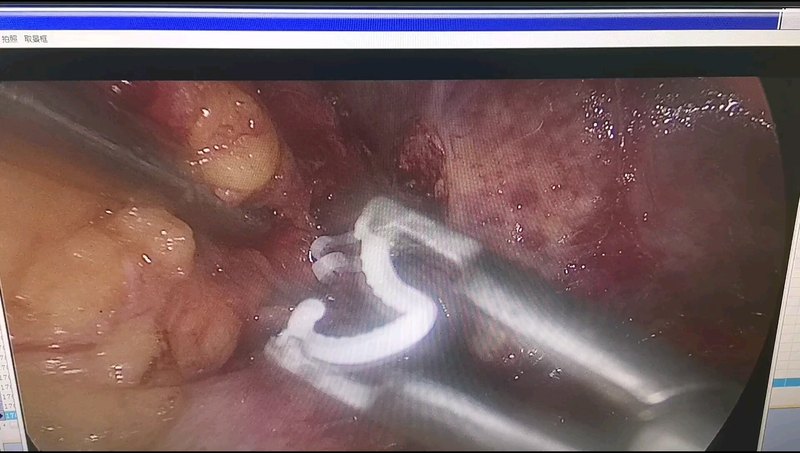 肾上腺切除时中央静脉的处理。微创手术快速康复。让这类高血压患者得到更好的治疗。