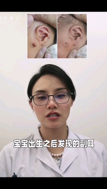 宝宝小副耳，不带软骨的，可以考虑趁早激光切除