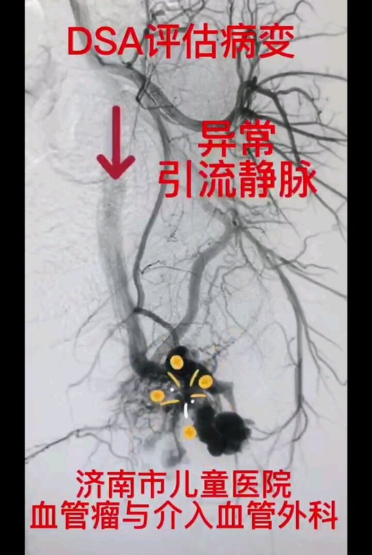 儿童动静脉畸形治疗过程。