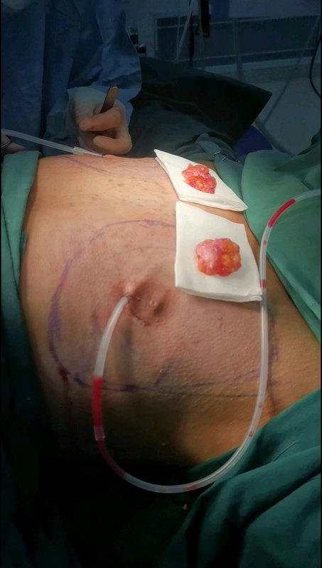 男性乳房发育吸脂结合乳晕切口乳腺切除术