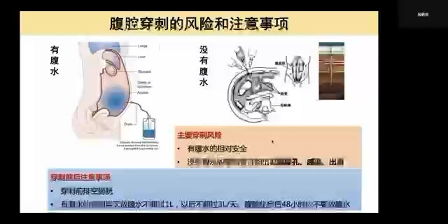 腹腔穿刺的风险和注意事项