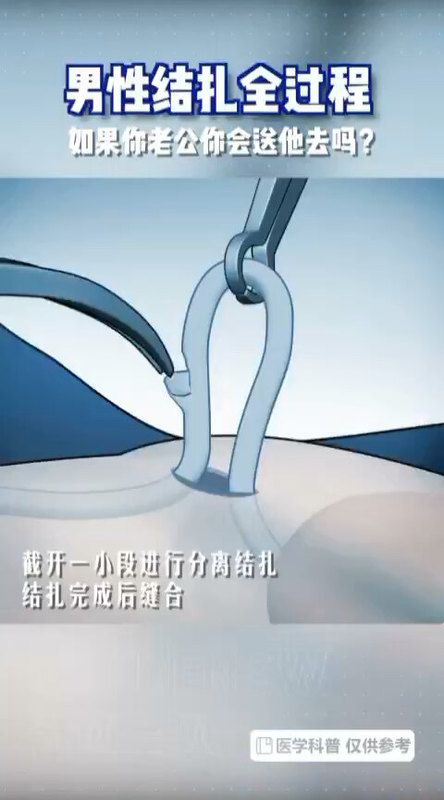 男性结扎全过程