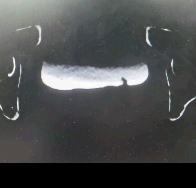 膀胱奇异肿块，从医30年没见过！术后病理：黄色瘤。查询文献，全球只报道22例，少见的膀胱良性肿瘤。