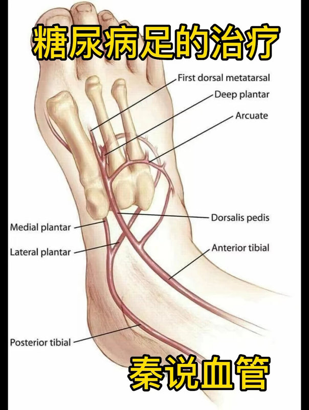 糖尿病足的治疗