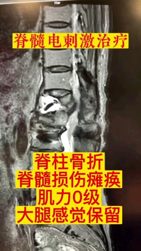脊髓电刺激治疗瘫痪