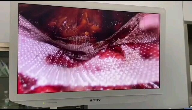 脐疝后鞘后修补TVS（totally visceral sac separation）疼痛轻恢复快！