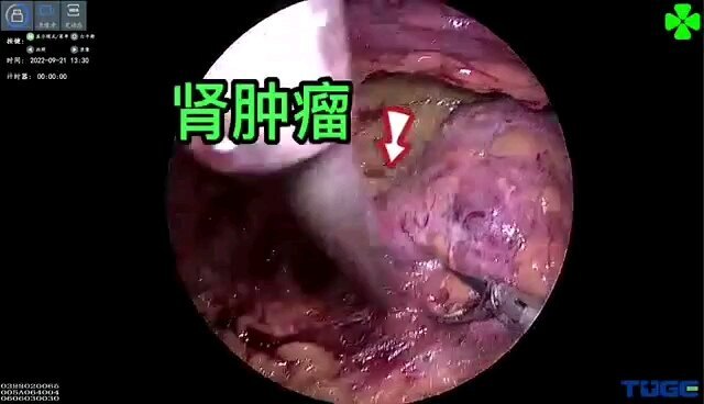 肾脏肿瘤，早发现早治疗
                    选用保留肾脏的手术方式