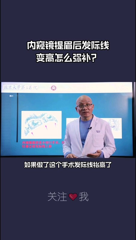 内窥镜提眉术后发际线变高了该怎么弥补？