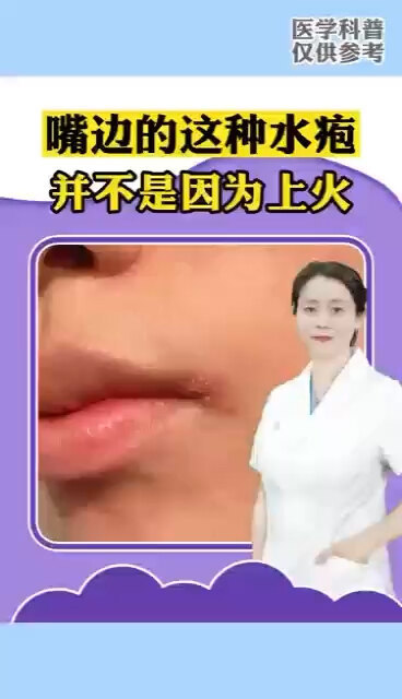 嘴边的这种水疱并不是因为上火