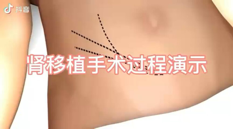 《肾移植手术全程演示》——＃医学科普＃肾移植＃尿毒症