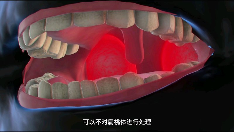 在腺样体手术同时，需要对扁桃体进行处理吗？