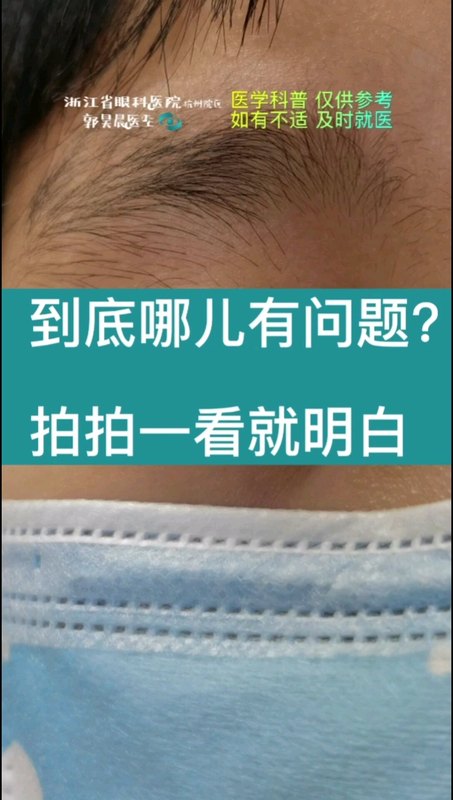 睑内翻倒睫到底是什么样的？