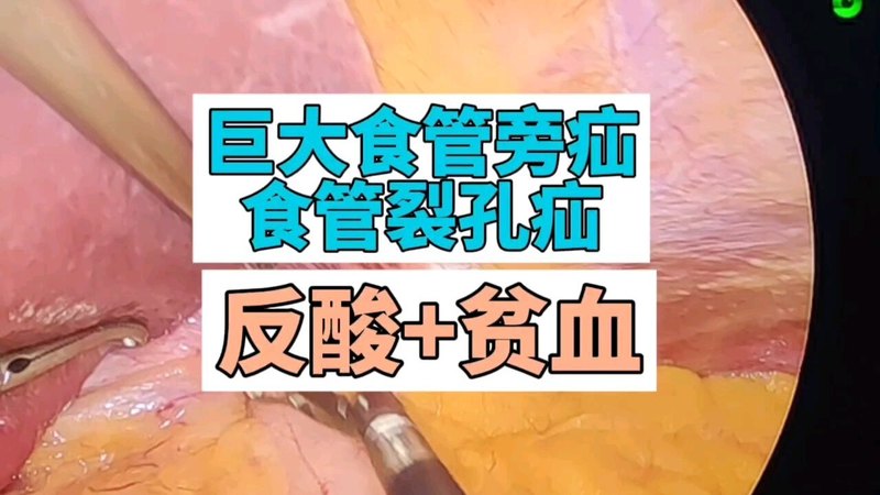 食管裂孔疝视频