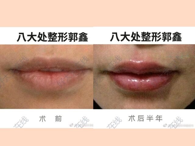 注射丰唇
