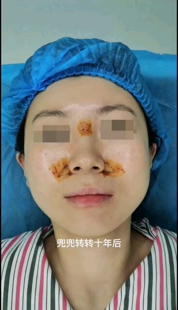 十年前因害怕手术而选择欧美定和玻尿酸隆鼻.....十年后进行膨体鼻修复