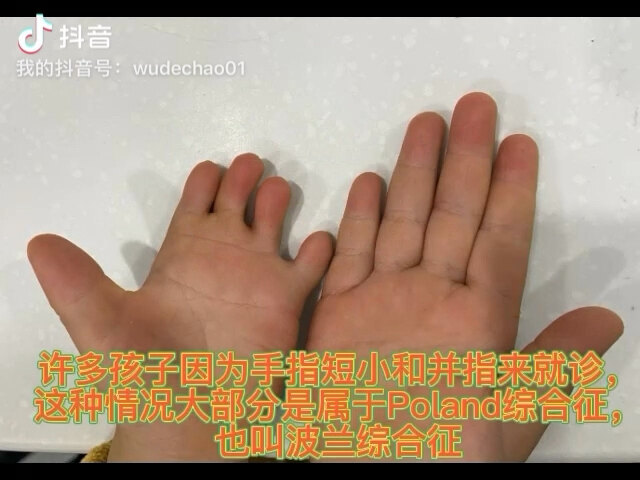 Poland综合征，波兰综合征（一）