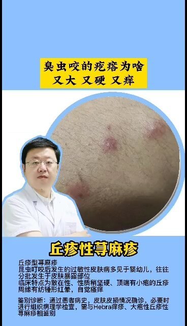 臭虫咬的疙瘩为啥又大 又硬 又痒！