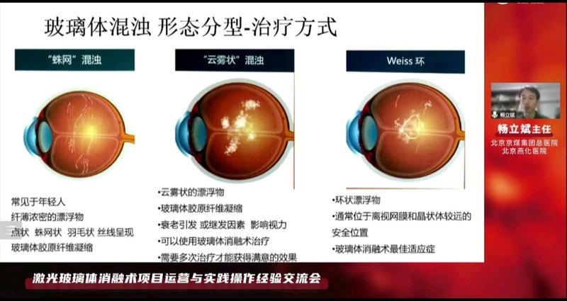 飞蚊症的分类与激光实例