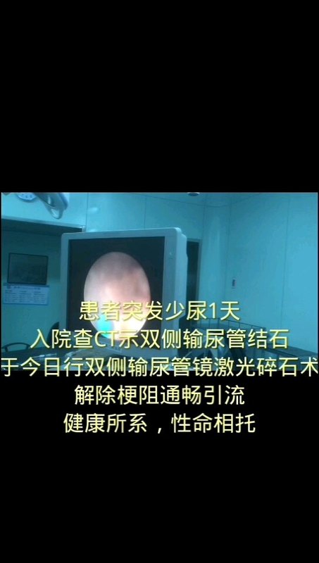 双侧输尿管结石的微创手术治疗