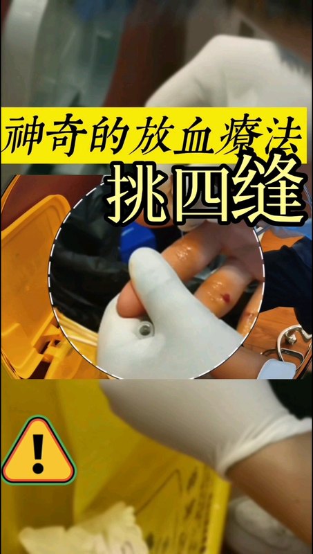 古老而神奇的放血疗法：挑刺四缝穴治疗小儿厌食、消化不良等