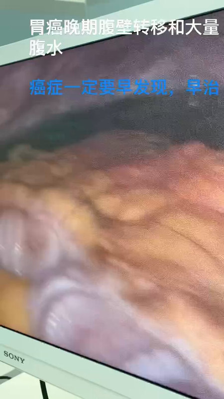 胃癌晚期腹部转移和腹水