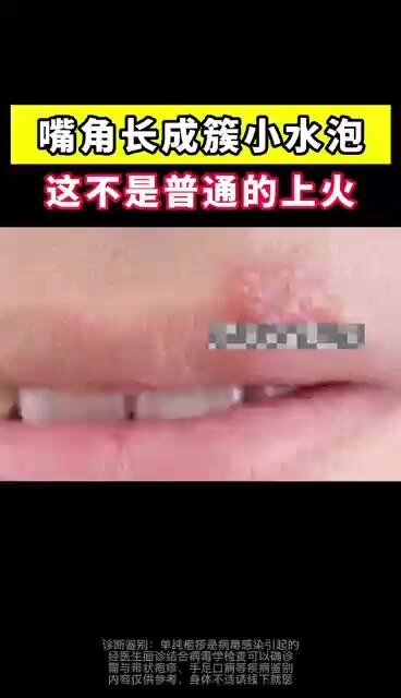 嘴角长成簇小水泡，这可不是普通上火，听听医生怎么说