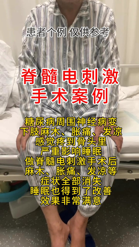 糖尿病下肢周围神经病变脊髓电刺激手术治疗案例案例