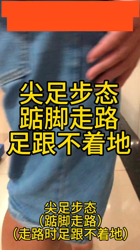 尖足步态：踮脚走路/走路时足跟不着地。